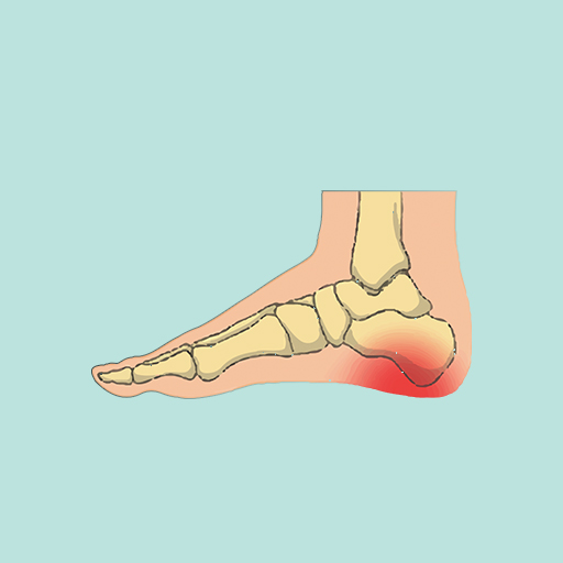 Plantar Fasiit & Topuk Dikeni