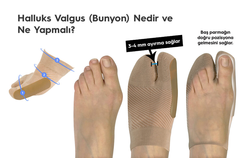 Halluks Valgus (Bunyon) Nedir ve Ne Yapmalı?