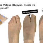Halluks Valgus (Bunyon) Nedir ve Ne Yapmalı?