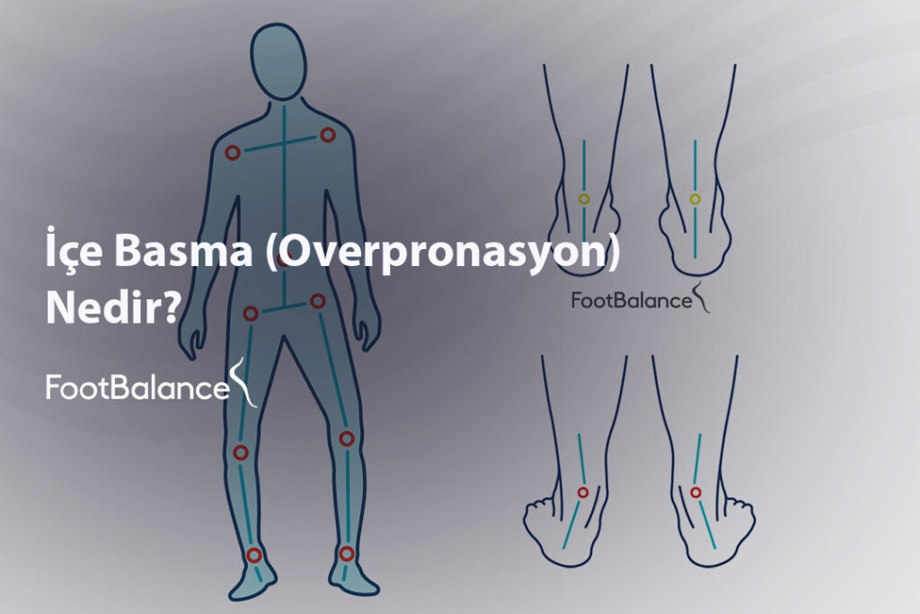 İçe Basma (Overpronasyon) Nedir?